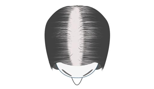 alopecia Developing Stage