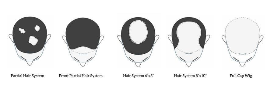 hair-system-types-for-different-size-of-baldness-1