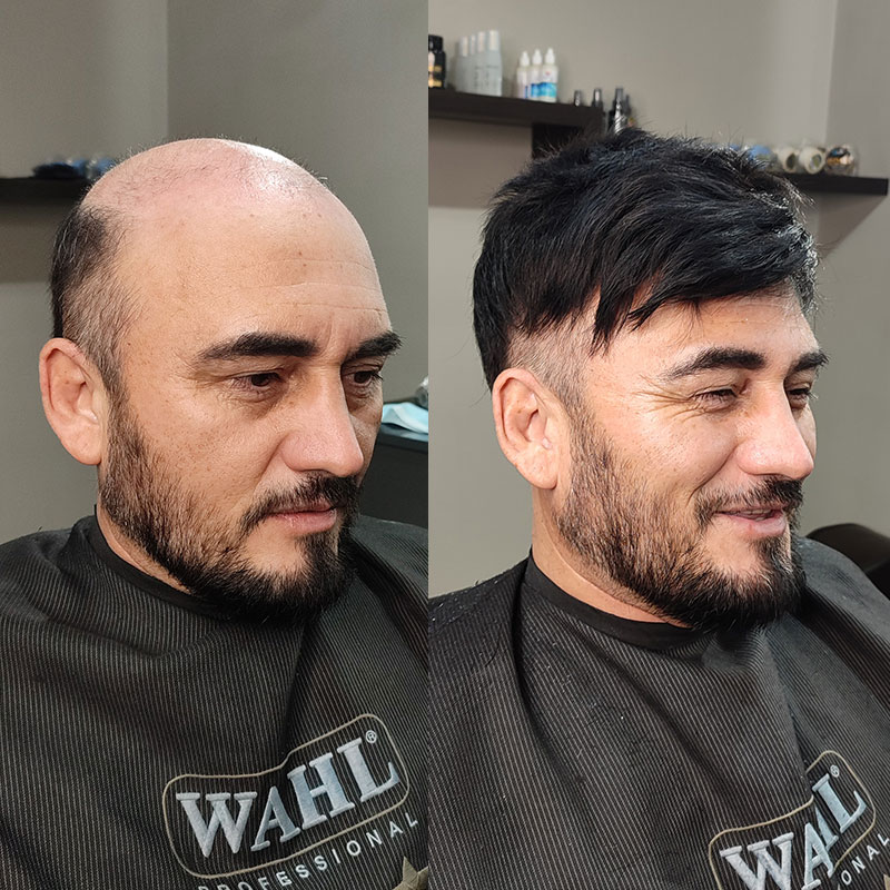 D7-3 C1A hair system before and after