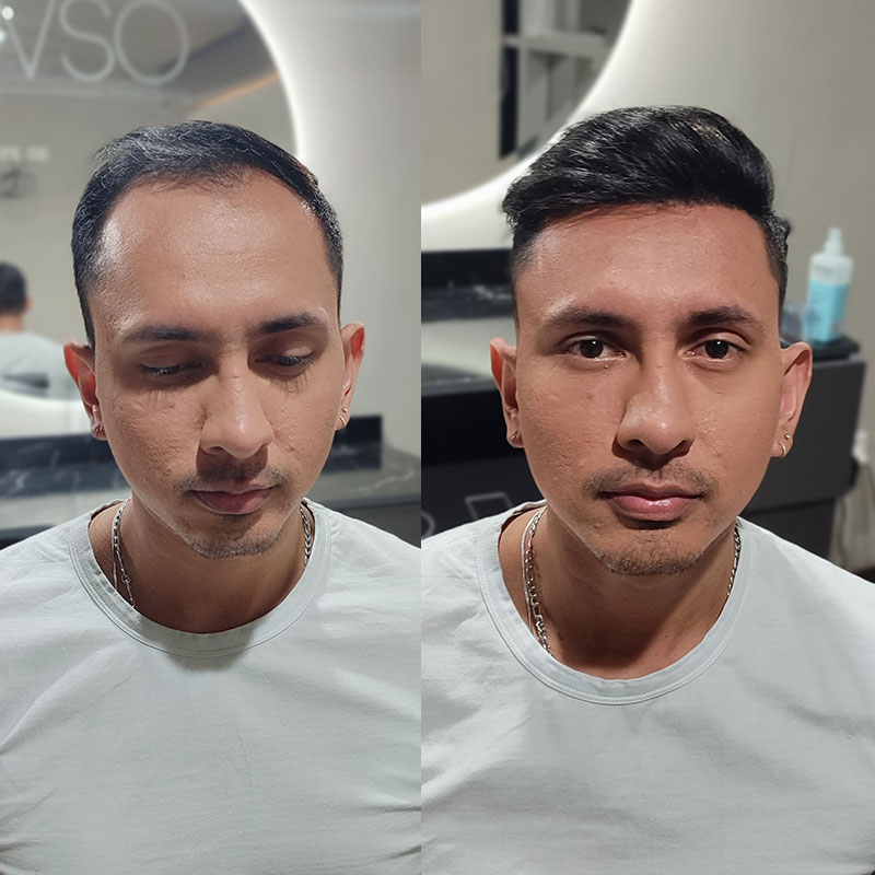 HS1V 1B frontal hair system before and after