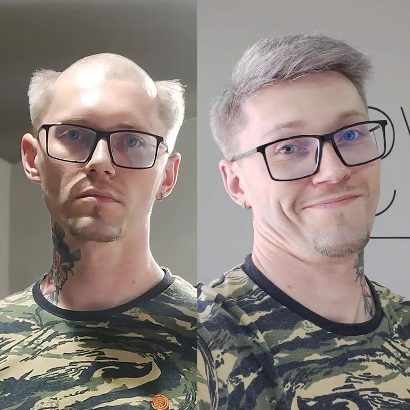 HS7 hair system before and after