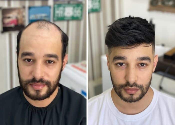 hair system for balding men before and after