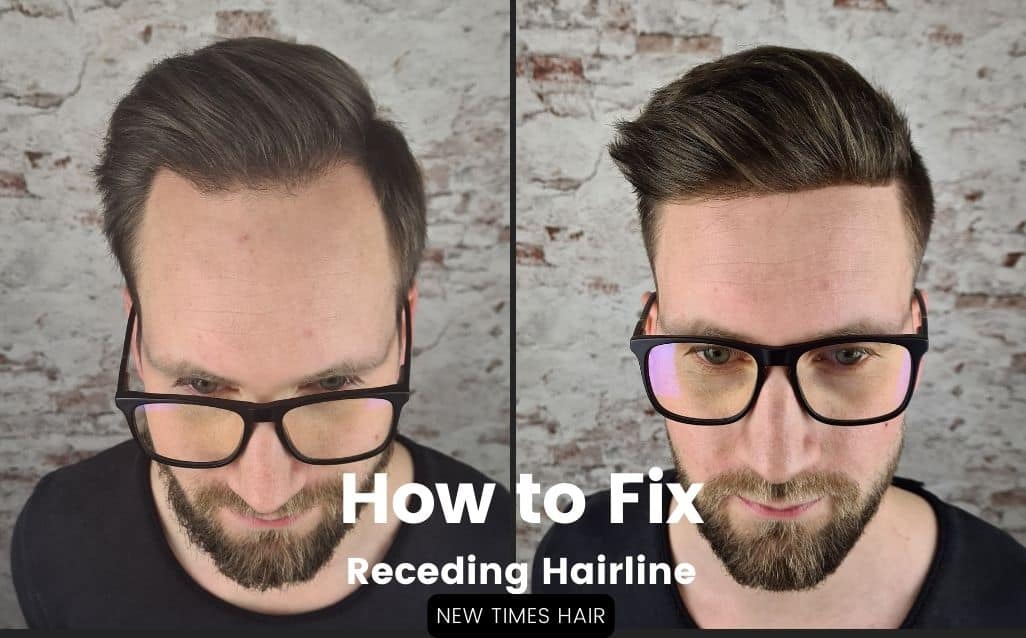 How-to-Fix-RECEDING-HAIRLINE