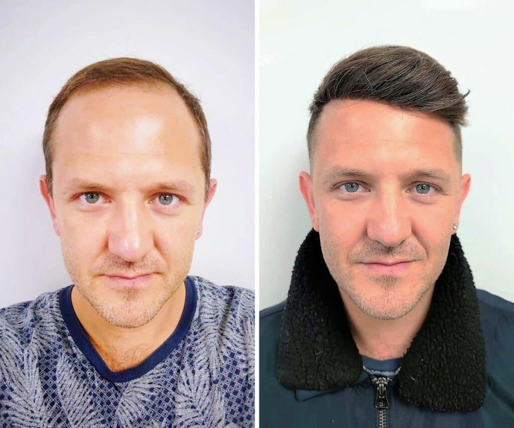 hair-system-haircuts-for-balding-men-before-and-after-4