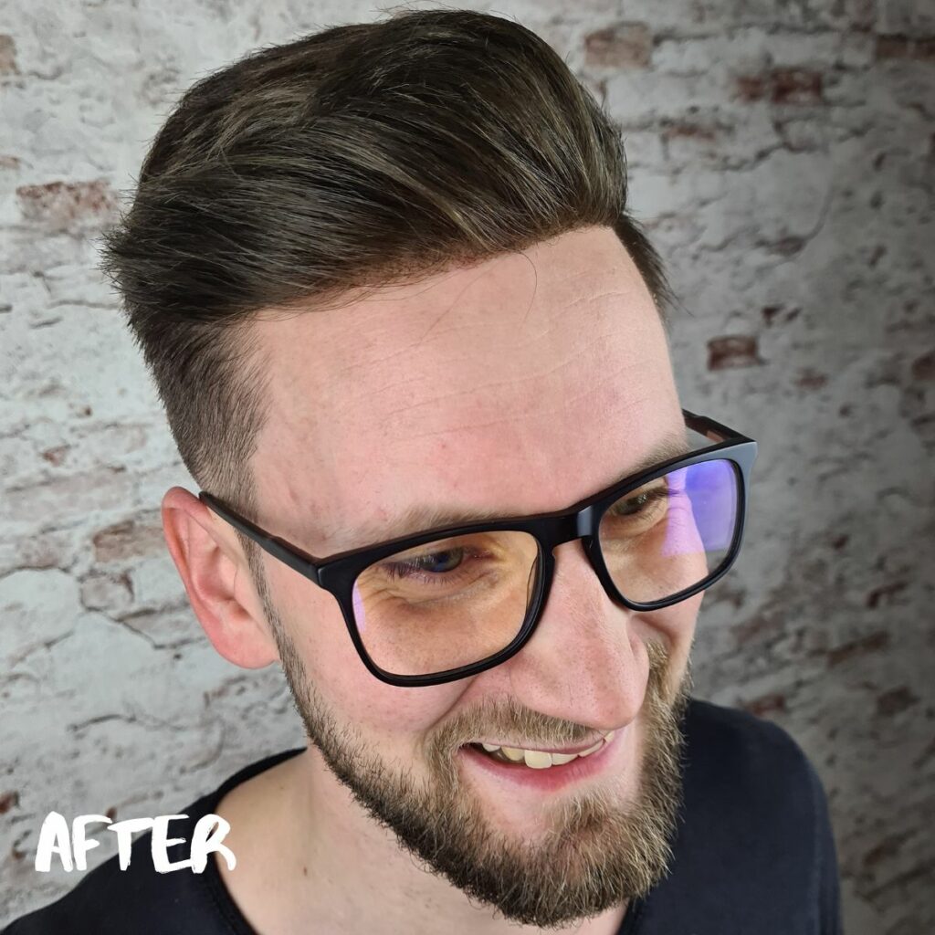 after-wearing-a-hair-system-before-and-after