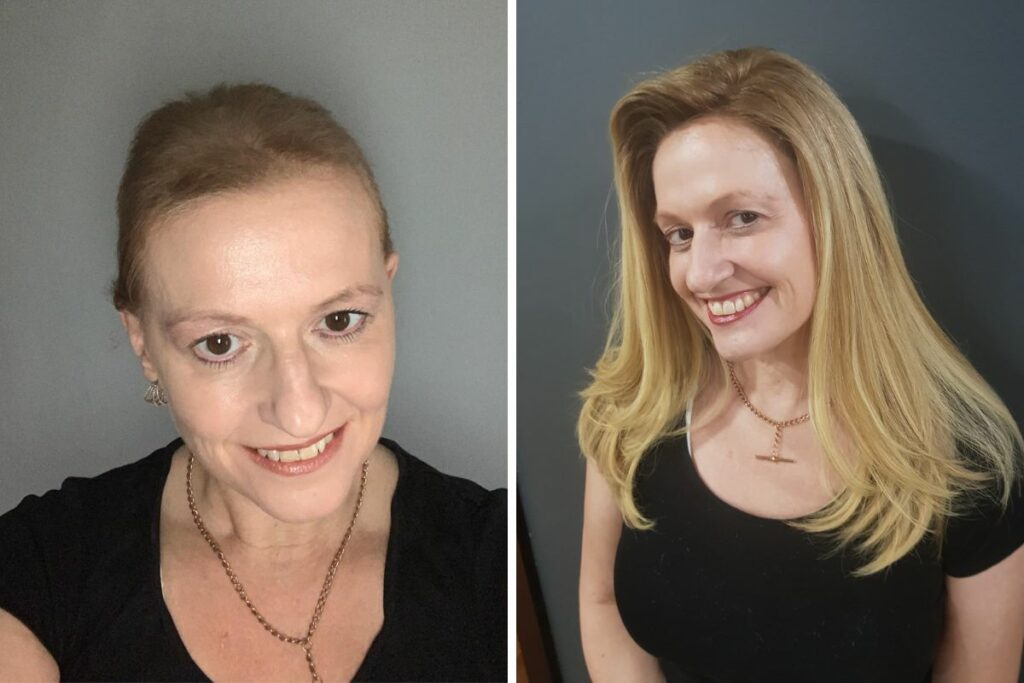 hair-extension-for-balding-crown-before-after-monot