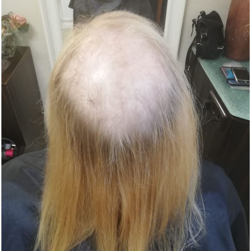 What-Is-Alopecia-2