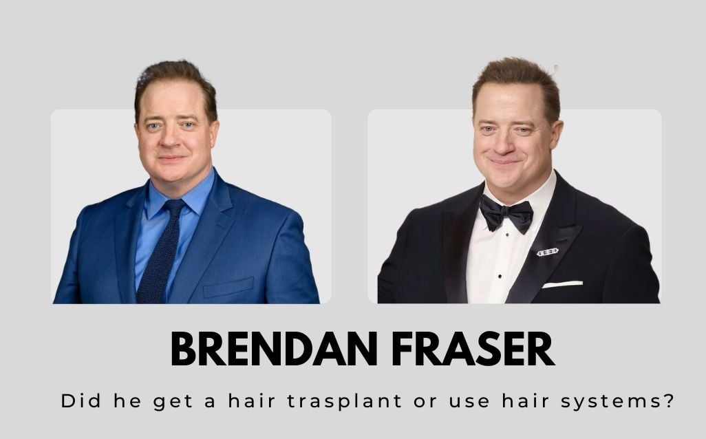 did brendan fraser had a hair transplant or wear wigs